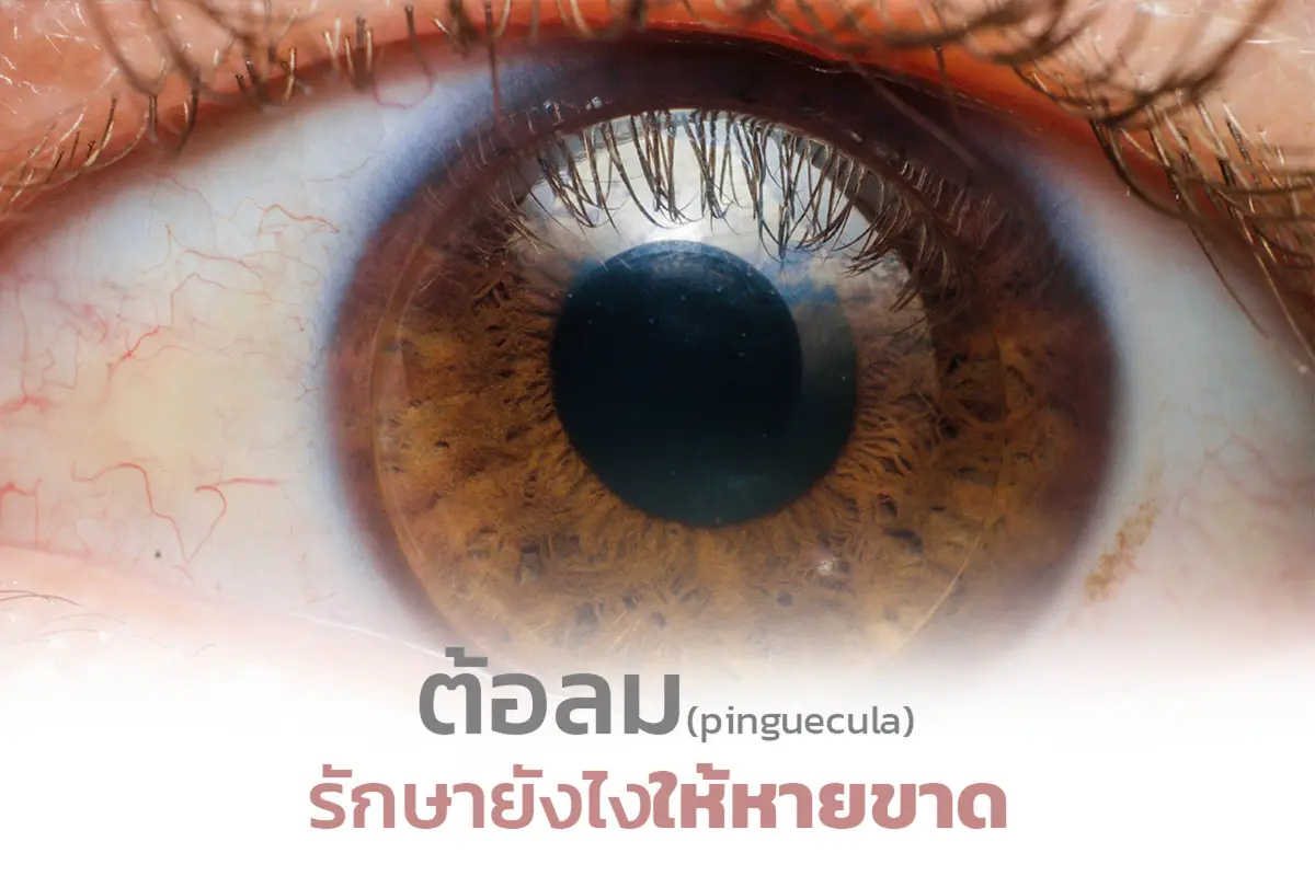  ต้อลม (pinguecula) รักษายังไงให้หายขาด