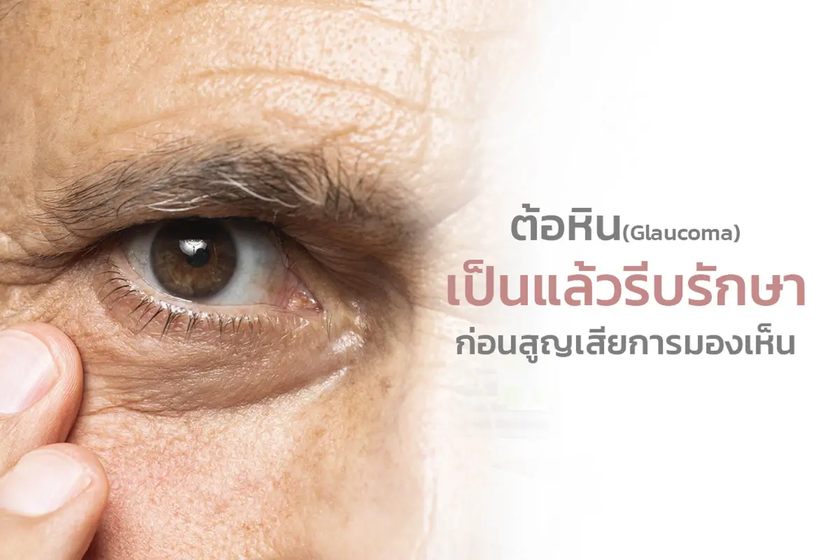  ต้อหิน (Glaucoma) เป็นแล้วรีบรักษา ก่อนสูญเสียการมองเห็น