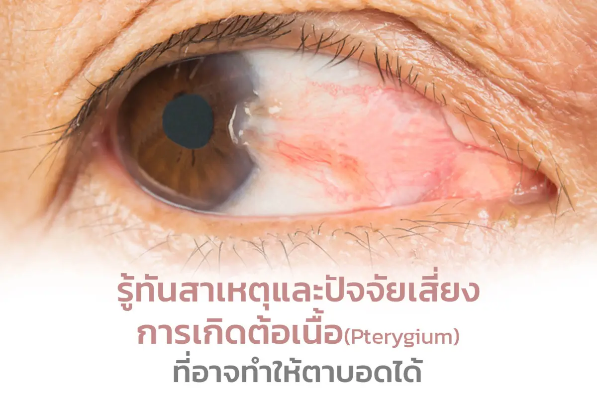  รู้ทันสาเหตุและปัจจัยเสี่ยงการเกิดต้อเนื้อ (Pterygium) ที่อาจทำให้ตาบอดได้