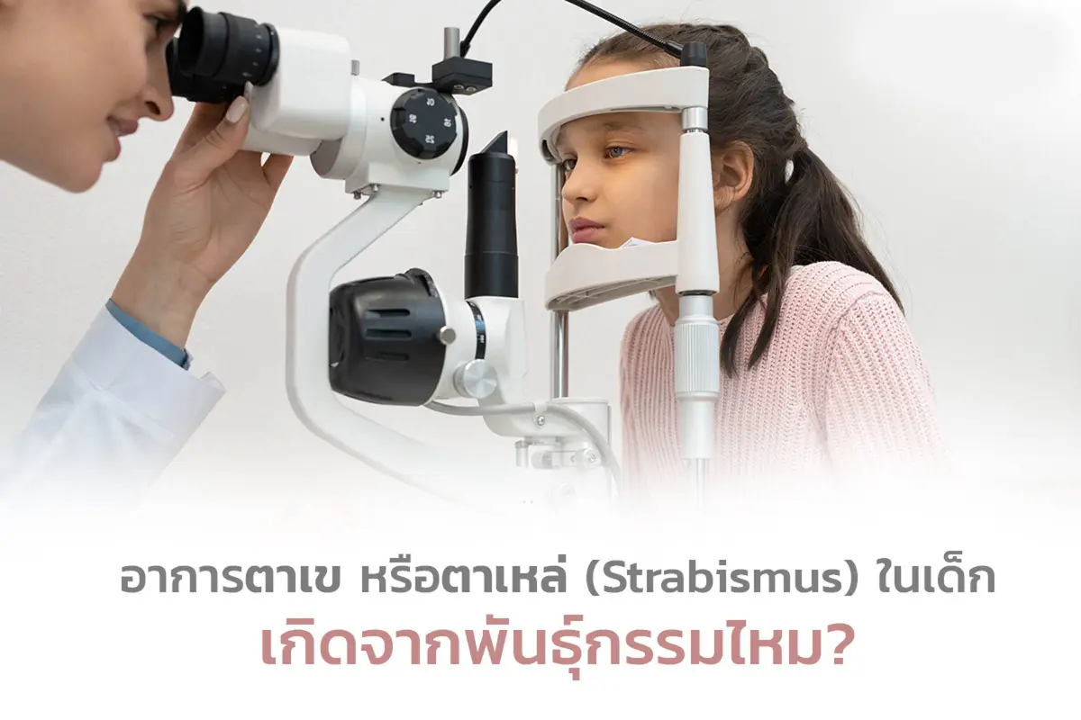  ไขข้อสงสัย อาการตาเข ตาเหล่ (Strabismus)ในเด็กเกิดจากพันธุกรรมจริงหรือ 