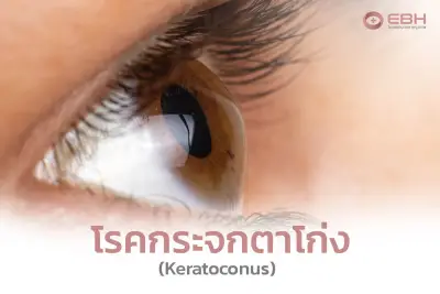  โรคกระจกตาโก่ง (Keratoconus)