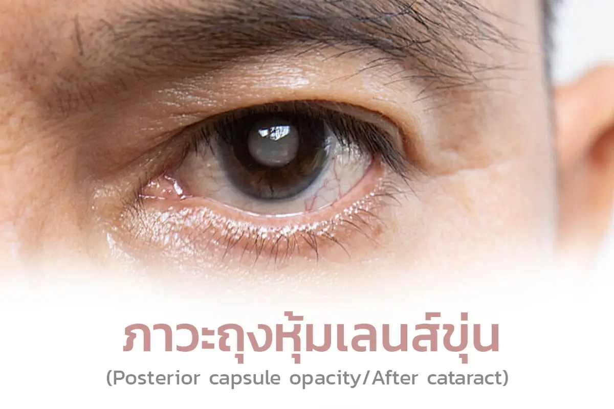  ภาวะถุงหุ้มเลนส์ขุ่น (Posterior capsule opacity/After cataract)