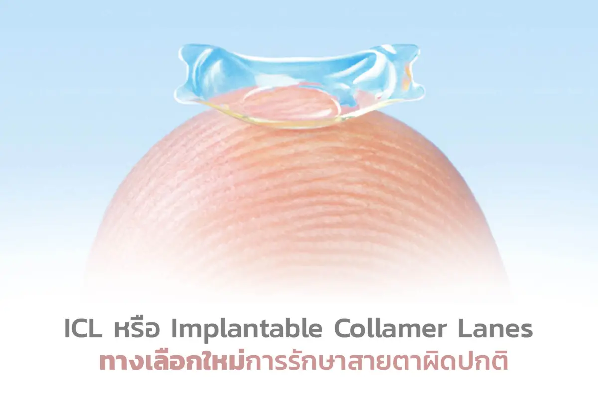  ICL หรือ Implantable Collamer Lens ทางเลือกใหม่การรักษาสายตาผิดปกติ