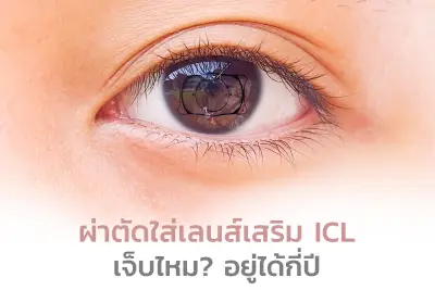  ผ่าตัดใส่เลนส์เสริม ICL เจ็บไหม? อยู่ได้กี่ปี