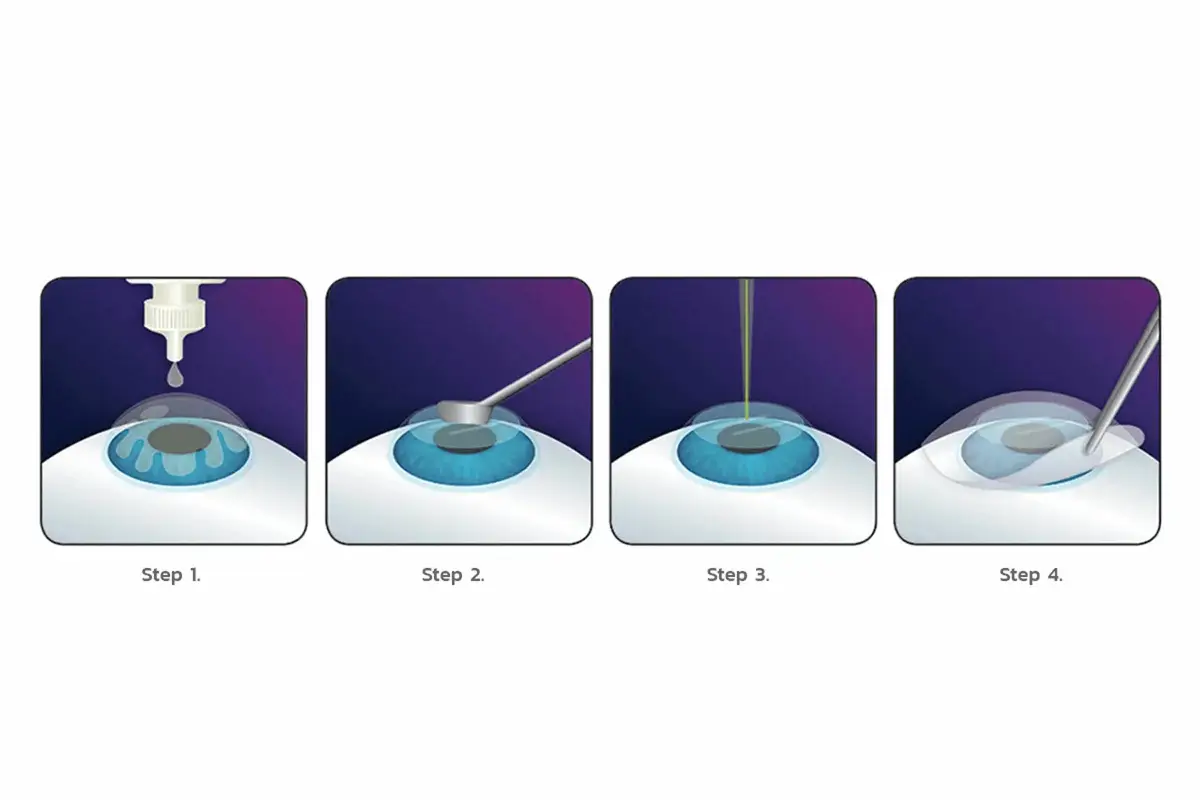 ศูนย์เลสิก PRK (Photorefractive Keratectomy) ผ่าตัดแก้ไขสายตาเทคนิคปรับแต่งความโค้งที่กระจกตาโดยตรง