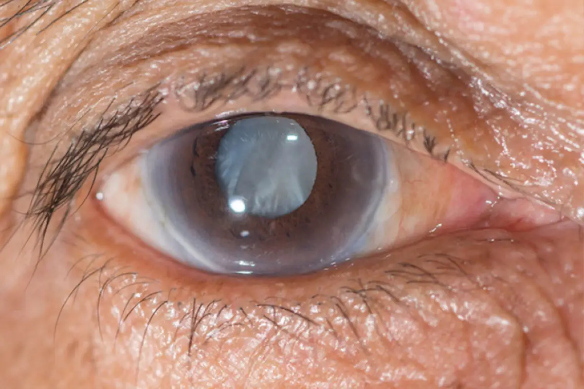 ศูนย์ตาและต้อกระจก เป็นต้อหิน (Glaucoma)​ รักษาหายไหม ​อา​การเป็นอย่างไร